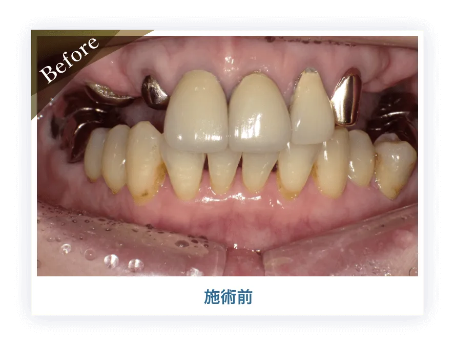 インプラント施術前
