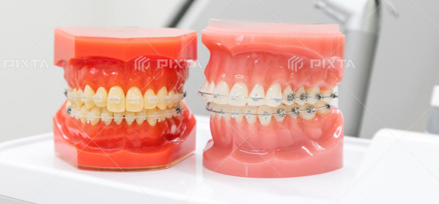 インプラント治療後はメンテナンスが必要！正しいメンテナンス方法について